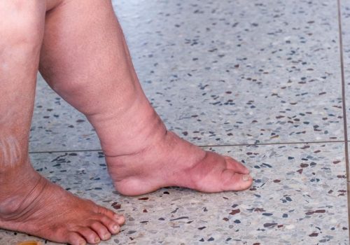 0.01995900_1697559704_filariasis